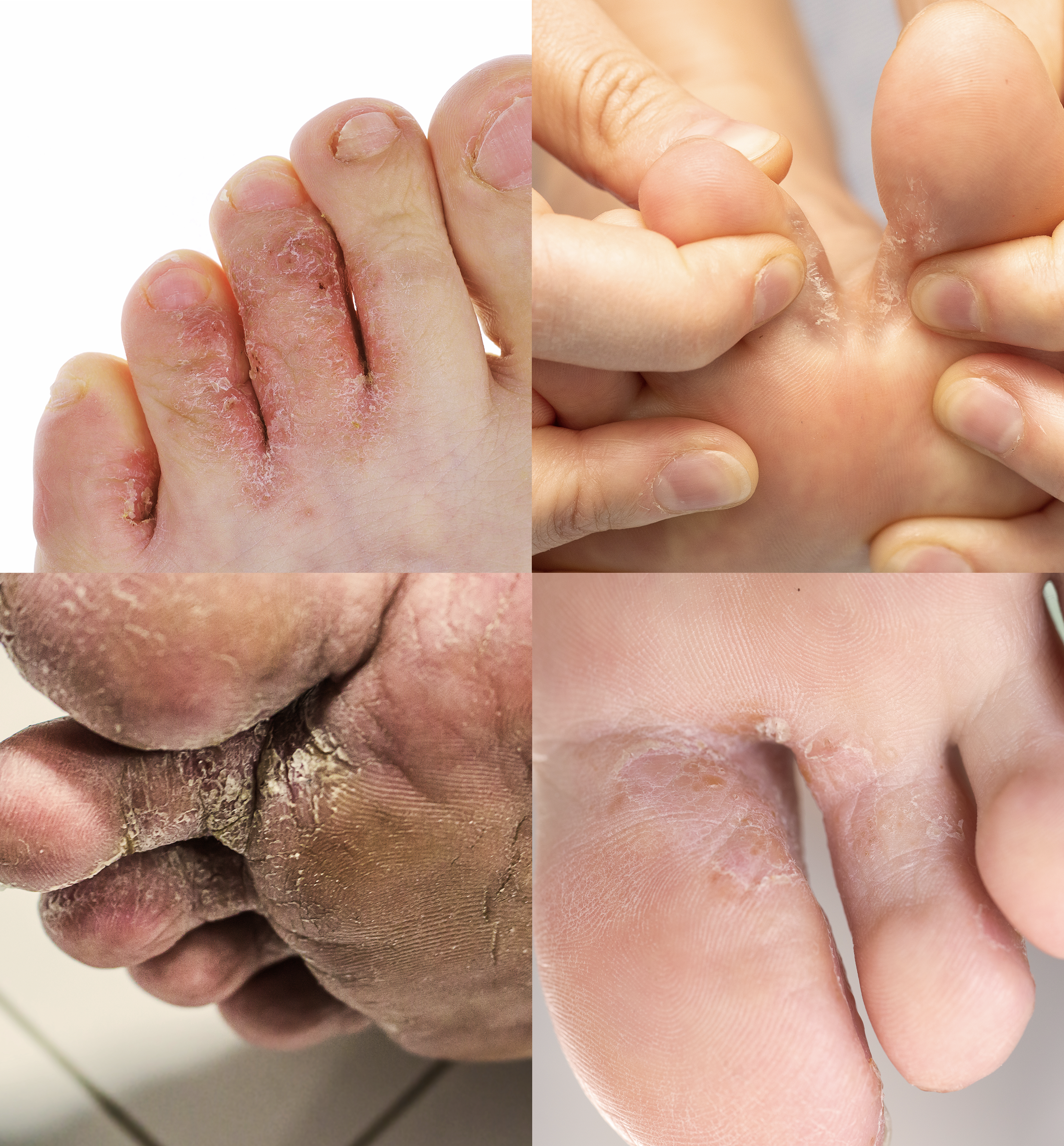 4 images of feet with athlete's foot fungus before use of Dryello